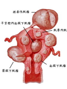 肌壁間肌瘤