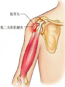 肱二頭肌長頭肌腱炎