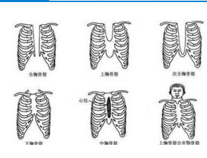 胸骨裂