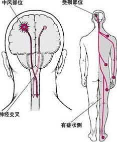 世界預防中風日