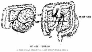 十二指腸旁疝 圖3