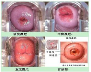 慢性子宮內膜炎