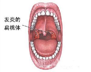 慢性扁桃體炎