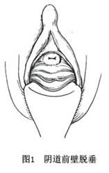 陰道前壁膨出
