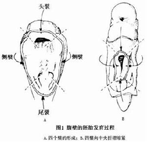 臍膨出