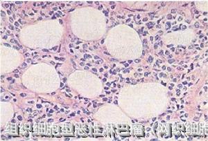 淋巴網狀細胞肉瘤