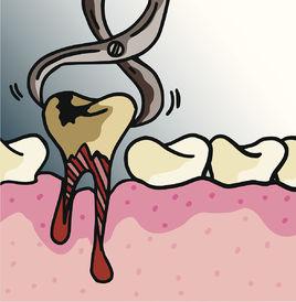 拔牙[口腔科治療技術]