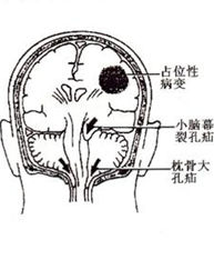 腦疝