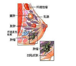 附屬檔案炎性包塊