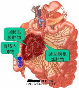 小腸腫瘤