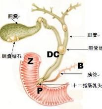 膽管癌