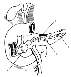 胰腺囊性纖維性變