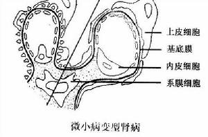 微小殘留病變