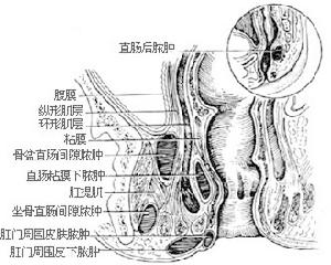 肛管直腸周圍膿腫