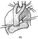 胸主動脈動脈瘤