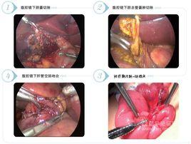 Roux-en-Y膽總管囊腫空腸吻合術