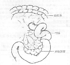 胰腺異位