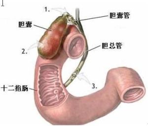 十二指腸炎