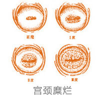 宮頸糜爛