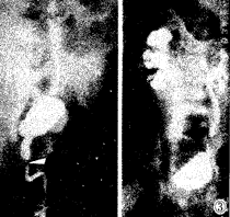 急性腎盂腎炎