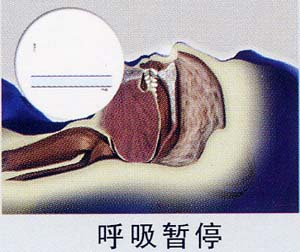 阻塞性睡眠呼吸暫停綜合徵