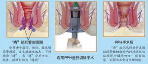 PPH治療示意圖