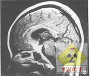 小兒結核性腦膜炎