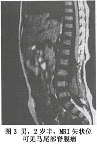 小兒椎管內腫瘤