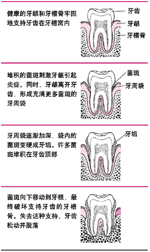 戰壕口炎