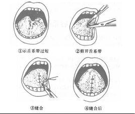 舌系帶過短矯正