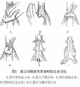 腹部大血管損傷