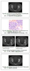 骨盆部位溶骨病變9例