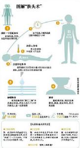 人頭移植[新型醫療技術]