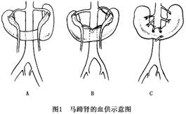 合併馬蹄腎的腹主動脈瘤