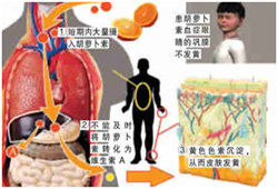 高胡蘿蔔素血症