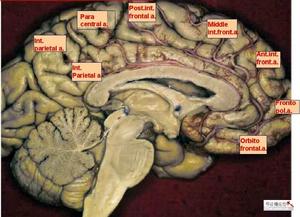 大腦前動脈閉塞綜合徵