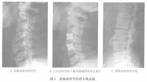 前縱韌帶骨化症