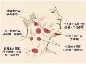 淋巴結腫大