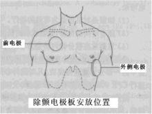 胸外電極放置部位