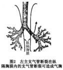 創傷性氣管及主支氣管損傷