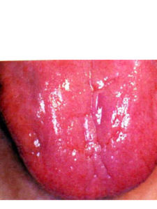舌乳頭炎