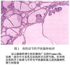 中毒性結節狀甲狀腺腫