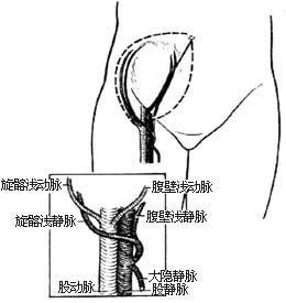 下腹部皮瓣切取術