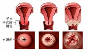宮頸癌