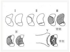 月狀骨無菌壞死