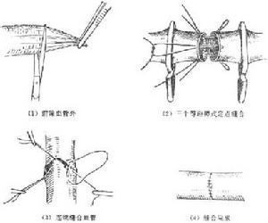 四肢血管損傷