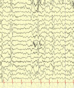 異常腦電圖