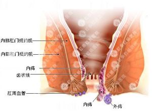 葡萄痔