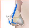 藍色為軟骨（純軟骨塑鼻）