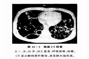 急性腎上腺皮質功能衰竭